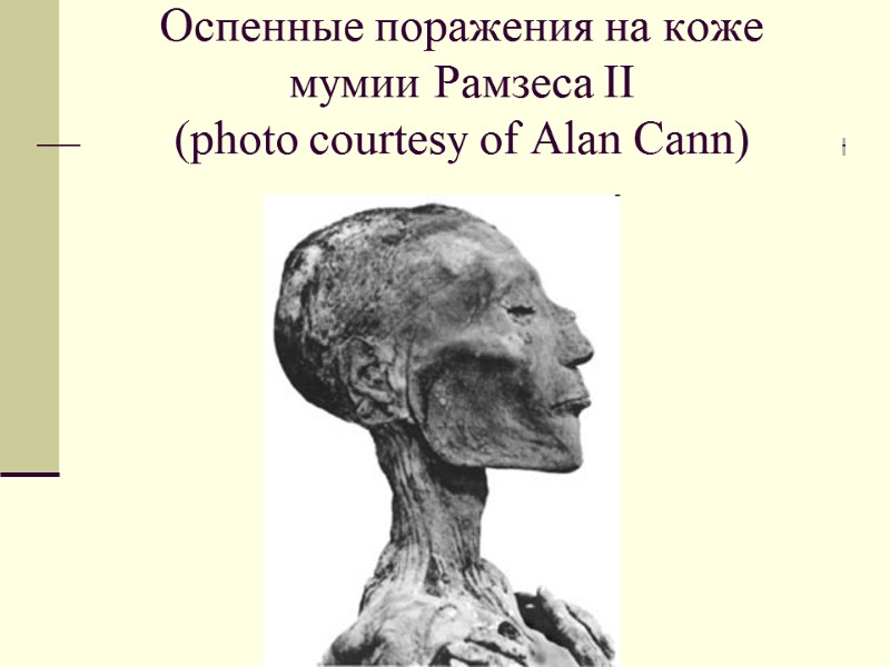 Оспенные поражения на коже мумии Рамзеса II (photo courtesy of Alan Cann)